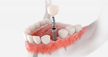 Implantes-dentales-odontologica-suiza-trujillo-peru