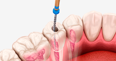 Endodoncia-odontologica-suiza-trujillo-peru