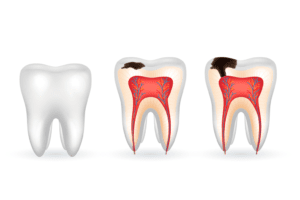 que es la caries, como manejarla y la importancia de prevenirla