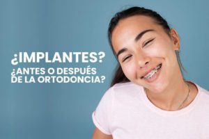 implantes-dentales