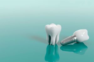 5 mitos sobre los implantes dentales- odontologica suiza - trujillo