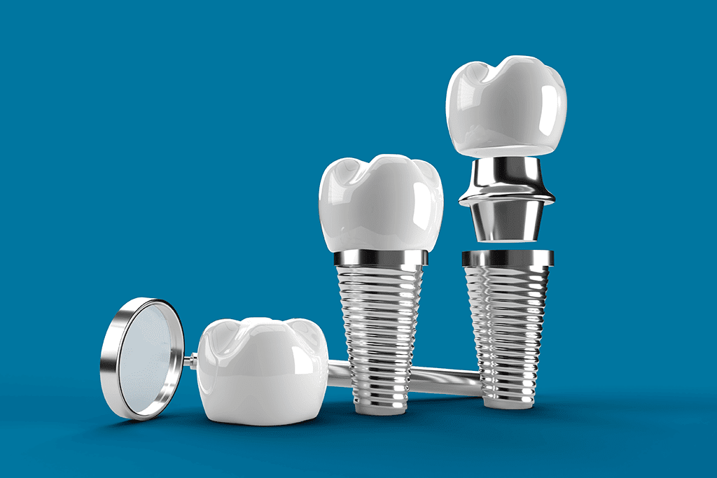 partes-de-los-implantes-dentales